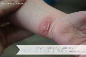 How I Healed My Toddler's Second Degree Burn With Herbs | GrowingUpHerbal.com | Here's how I treated a 2nd degree burn at home and what I used to heal it.